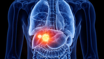 Liver-Cancer